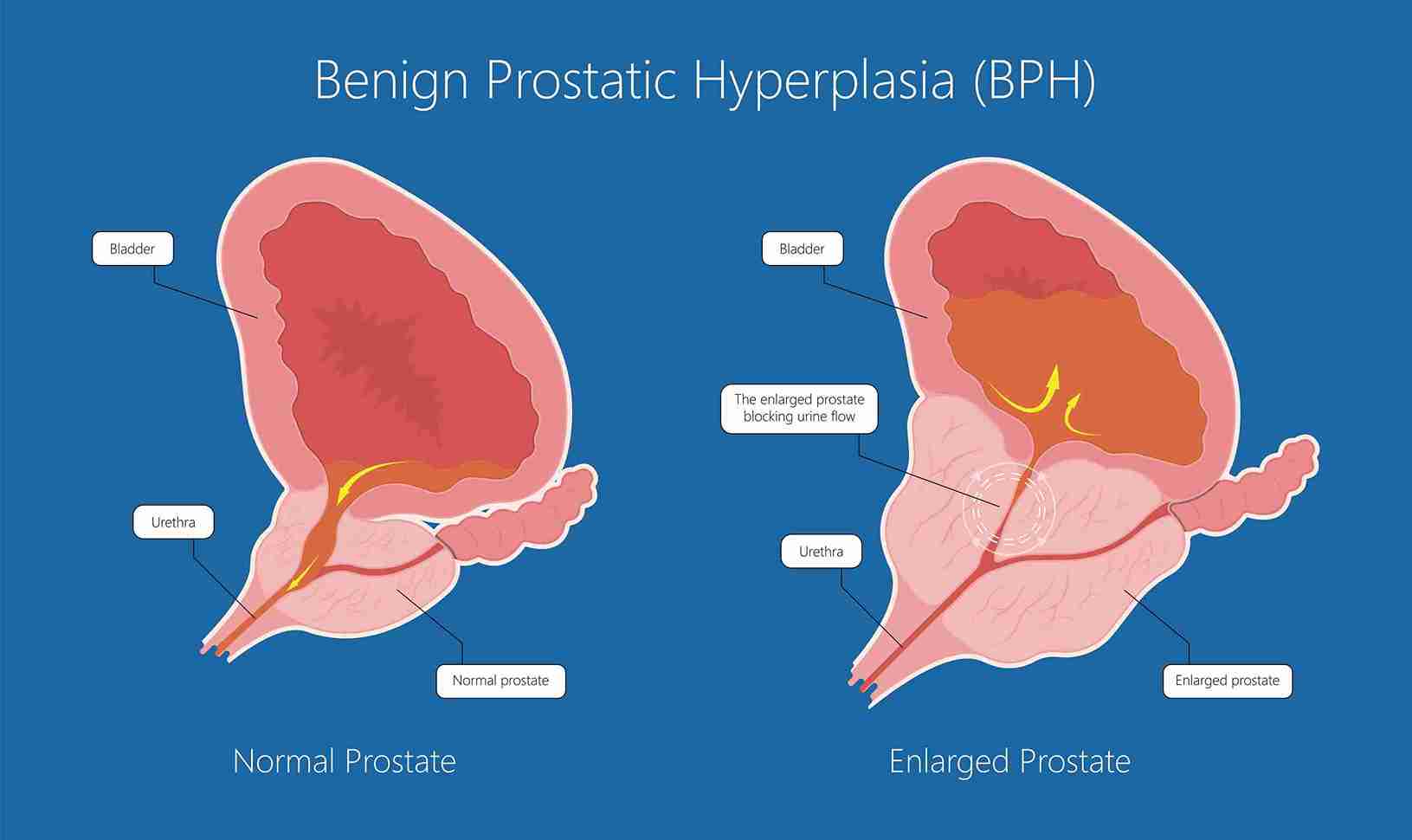 Prostate Biopsy Mumbai