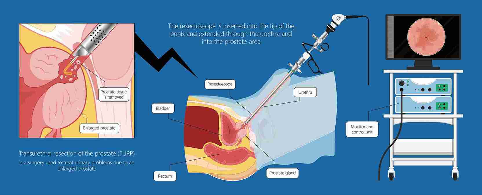 Prostate Biopsy Mumbai