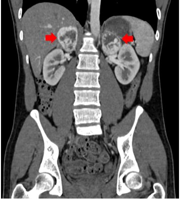 Robotic Surgery for Bladder Cancer Mumbai