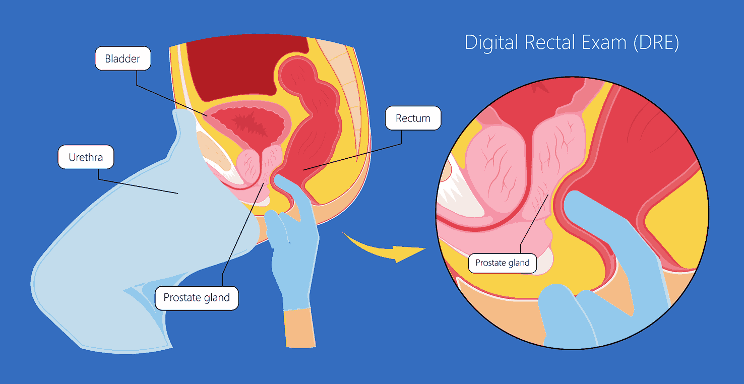 Prostate Biopsy Mumbai