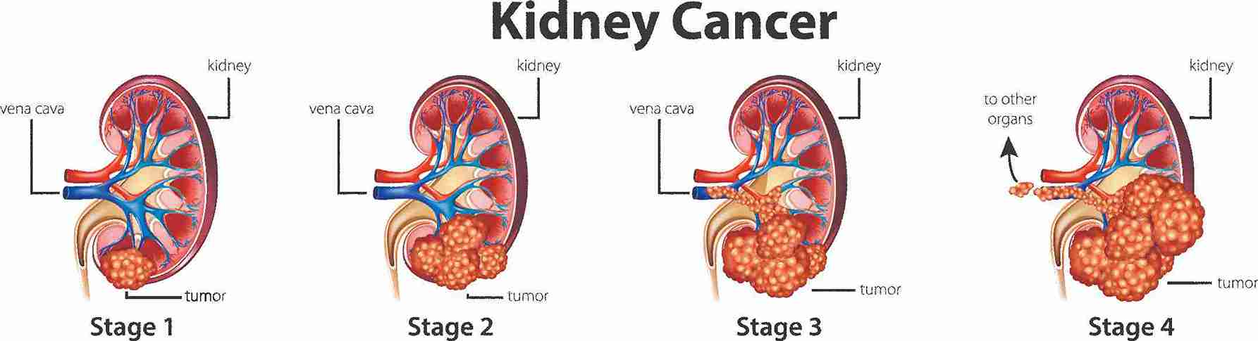 Advanced Kidney Cancer Surgery Mumbai