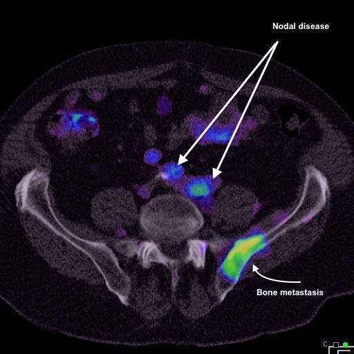 Prostate Biopsy Mumbai for Robotic Radical Prostatectomy