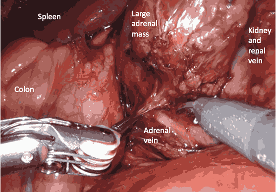 Bladder Tumour Biopsy Mumbai