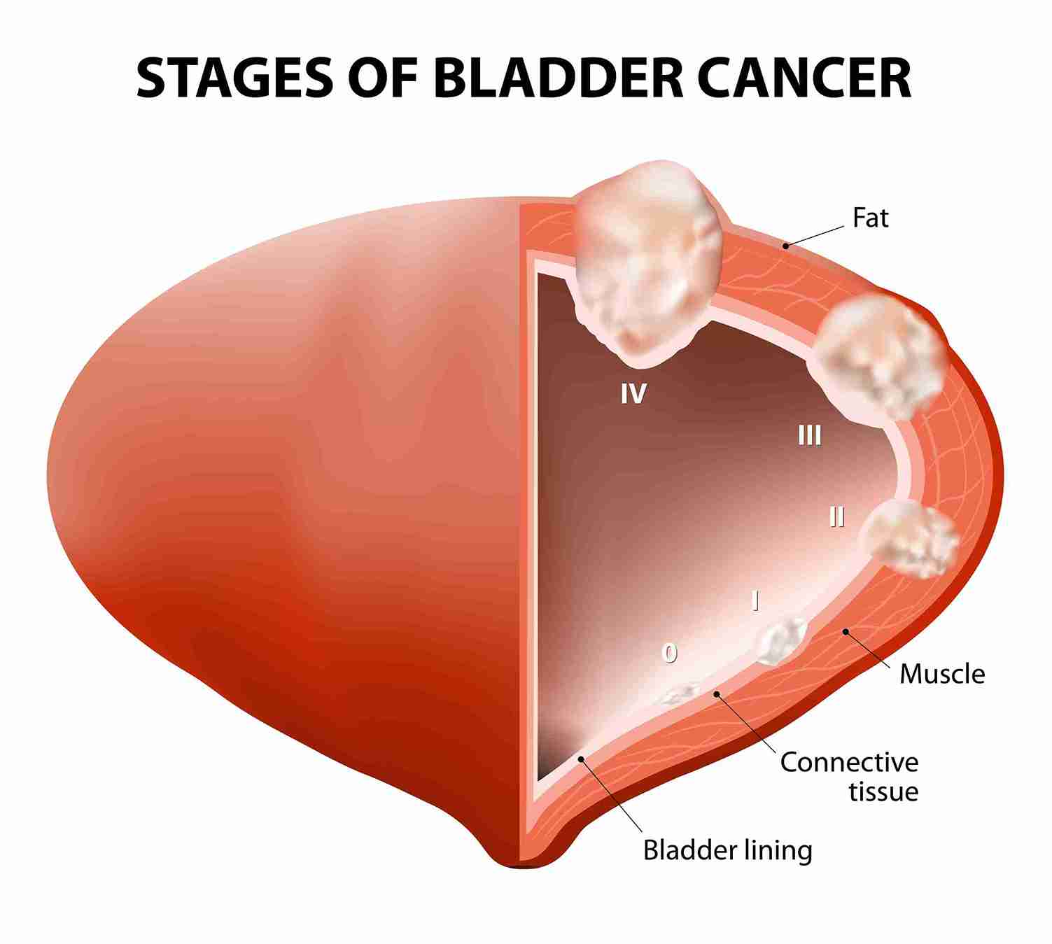 Robotic Surgery for Kidney Cancer Mumbai